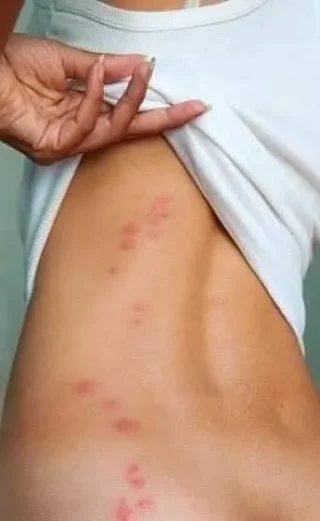 ي حشرة الفراش.  #البق أو كما تسمي (حشرة البق) 6