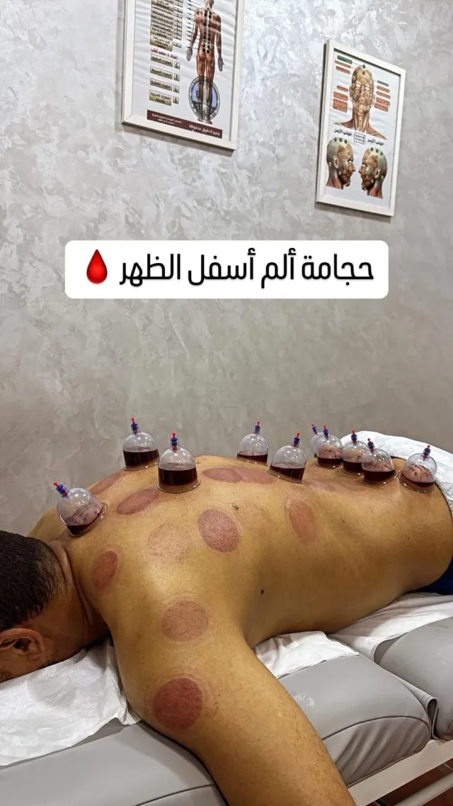 اخصائي مساج وحجامة 2