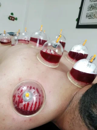حجامة بأنواعها كايروبرايتيك شياتسو مصل النحل رقية شرعية 12