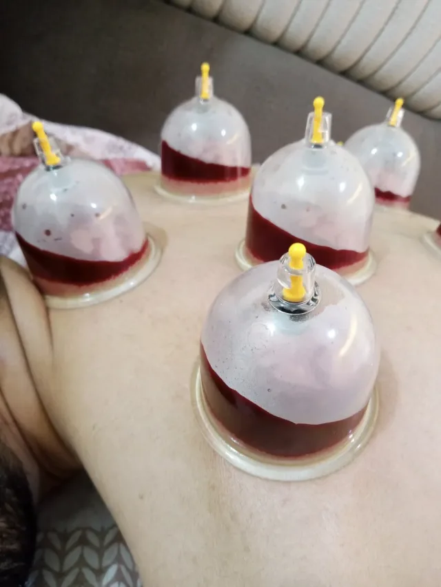 شرطة محجم للحجامة الوقائية والعلاجية 0799638221 2