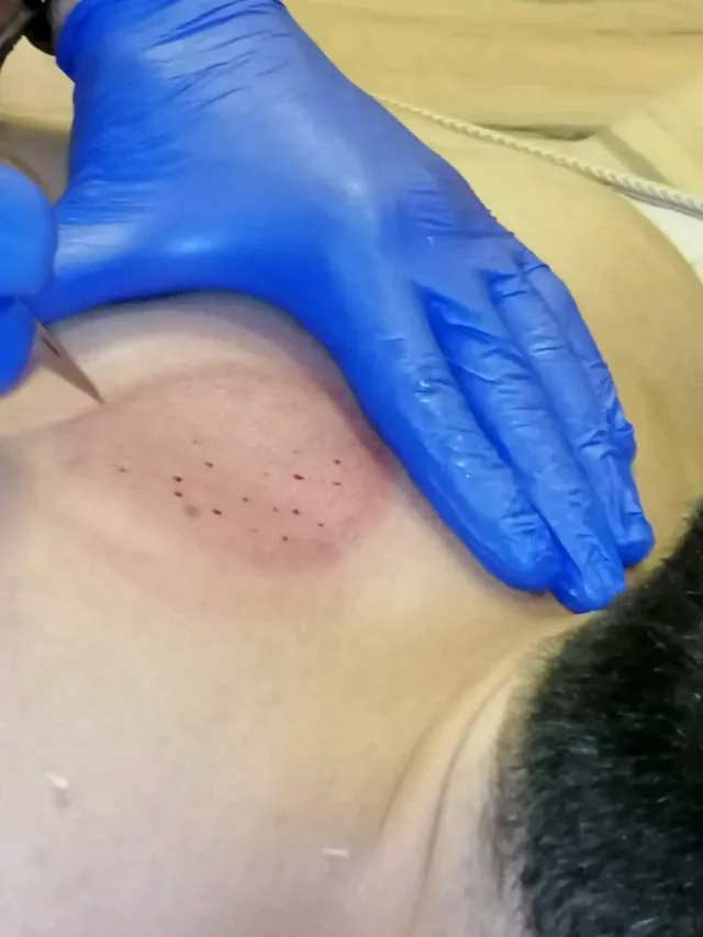 دكتور يزن للحجامه الطبيه 3