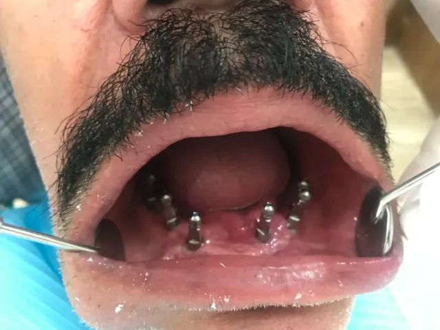 عيادات الصفدي والمومني لطب وزراعة وتقويم الاسنان 13