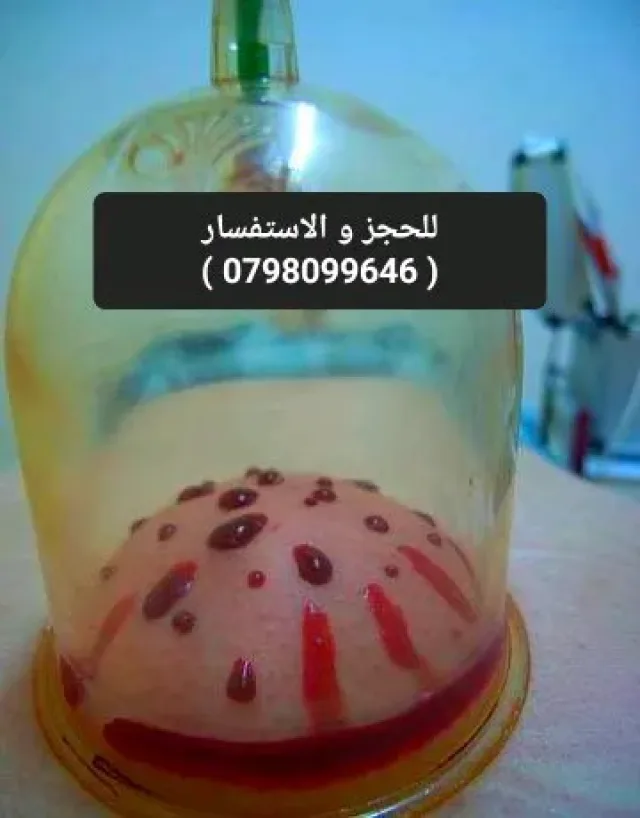 الحجامة النبوية و العلاجية 4