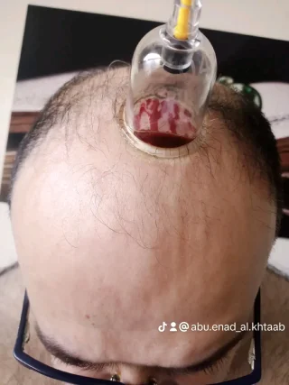 حجامة بأنواعها كايروبرايتيك شياتسو مصل النحل رقية شرعية 9