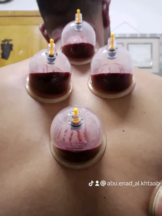 حجامة بأنواعها كايروبرايتيك شياتسو مصل النحل رقية شرعية 7