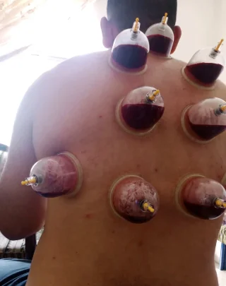 حجامة بأنواعها كايروبرايتيك شياتسو مصل النحل رقية شرعية 4