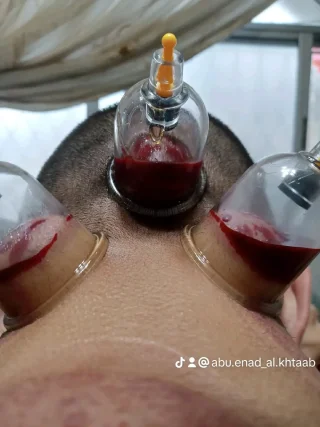 حجامة بأنواعها كايروبرايتيك شياتسو مصل النحل رقية شرعية 5
