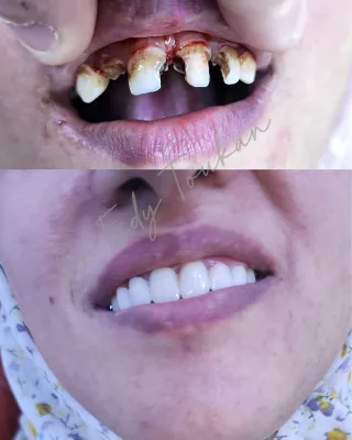 تركيبات الزيىكون