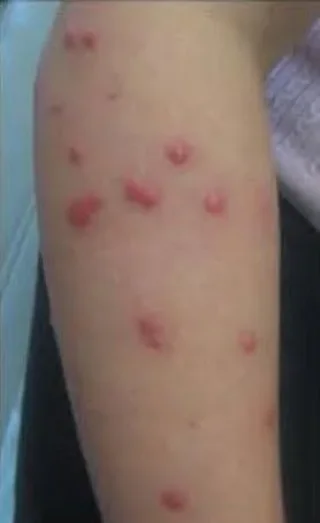 ي حشرة الفراش.  #البق أو كما تسمي (حشرة البق) 3