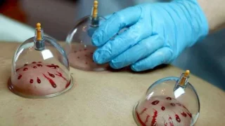 مركز حياه لخدمات الحجامة المنزلية (داخل عمان) 2