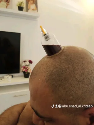 حجامة بأنواعها كايروبرايتيك شياتسو مصل النحل رقية شرعية 10