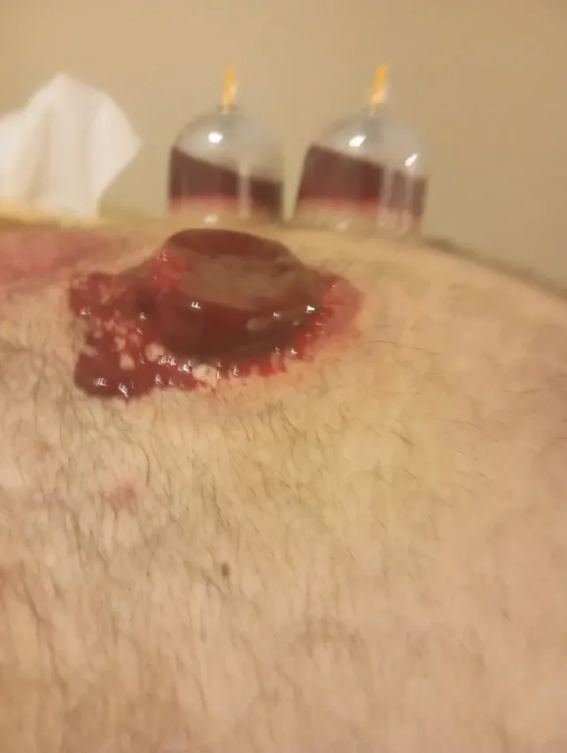 اخصائي مساج وحجامه 7