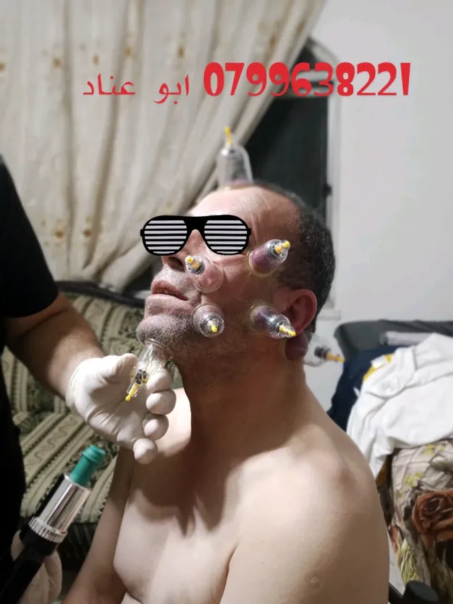 شرطة محجم للحجامة الوقائية والعلاجية 0799638221 5