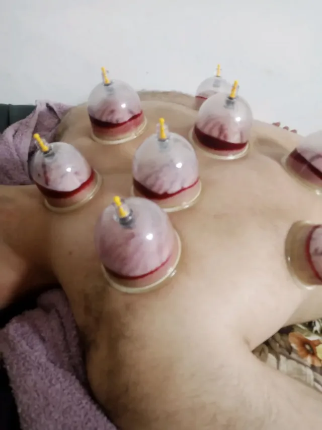 شرطة محجم للحجامة الوقائية والعلاجية 0799638221 7