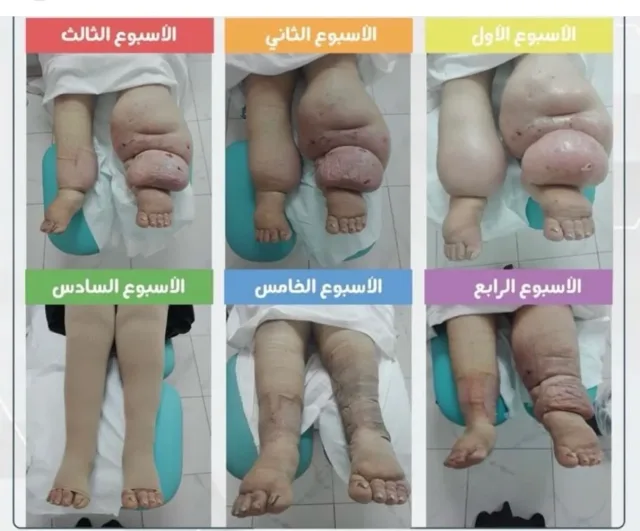 Leg and foot solutions