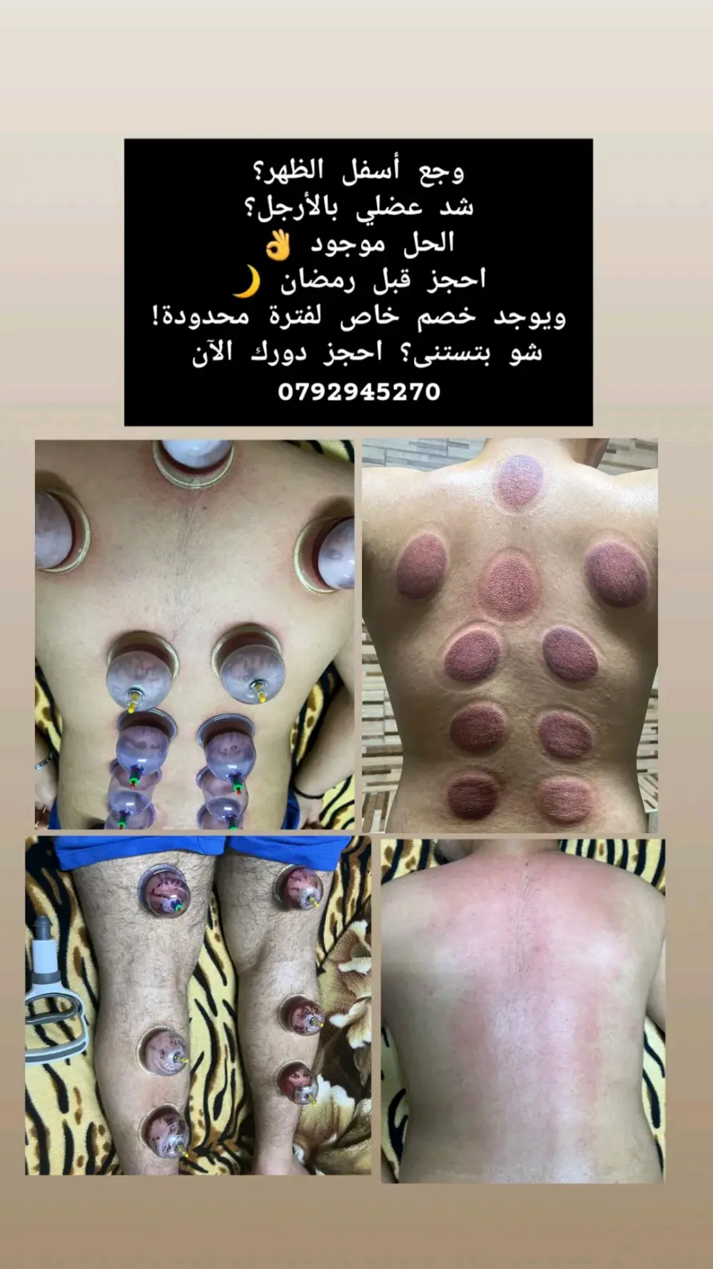 حجامه علاجيه وقائيه